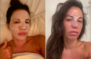 Máscara de colágeno absorvível + ativos do botox BiocollagenPlus