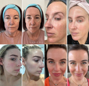 Máscara de colágeno absorvível + ativos do botox BiocollagenPlus